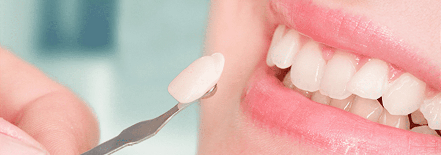 Direct Composite Veneers