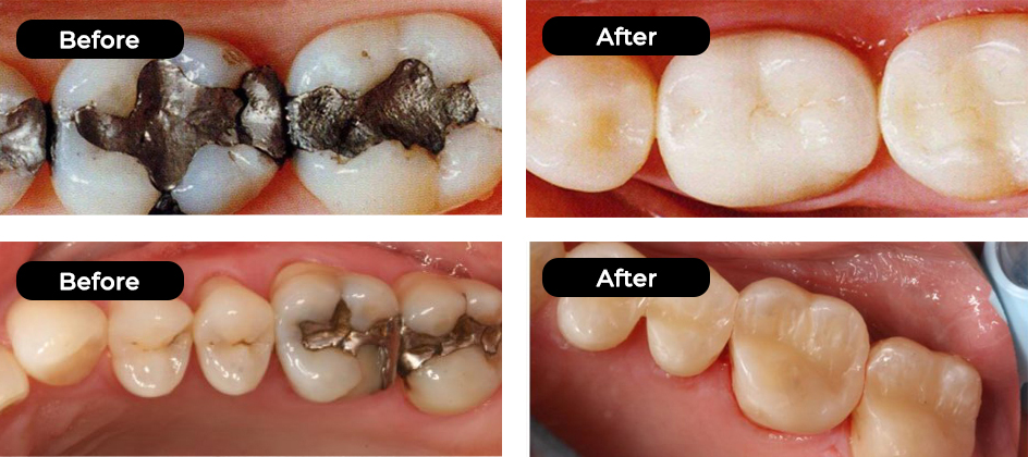 Cosmetic Composite White Fillings results