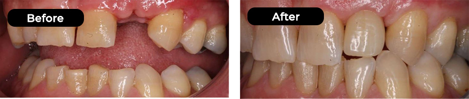 Cosmetic Crowns Bridges Dentures results