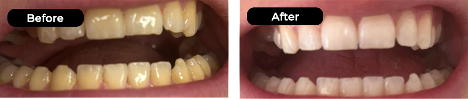 Teeth Whitening results