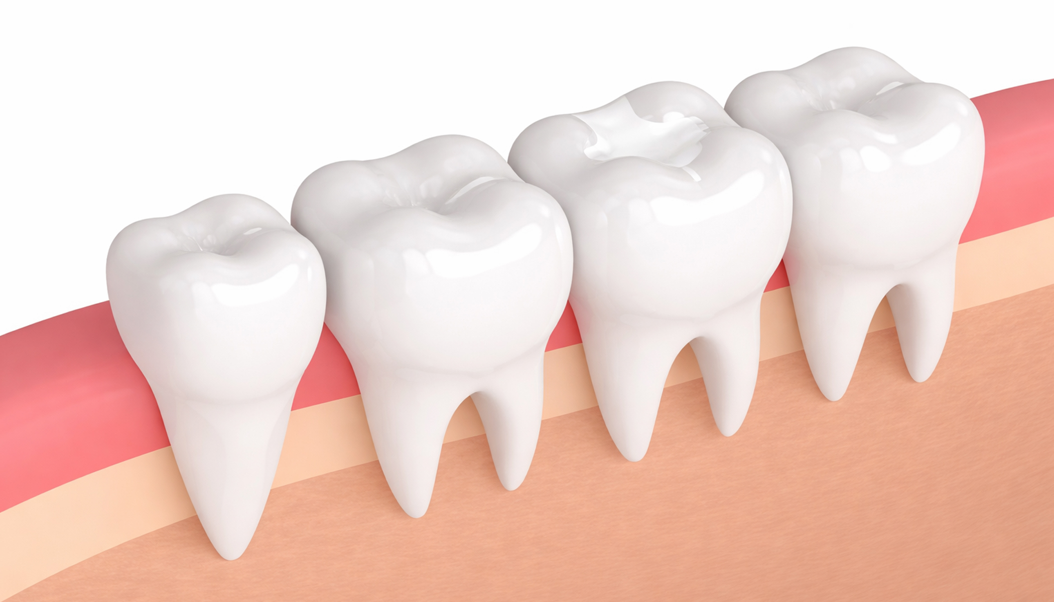 Cosmetic Composite White Fillings 3 banner_3